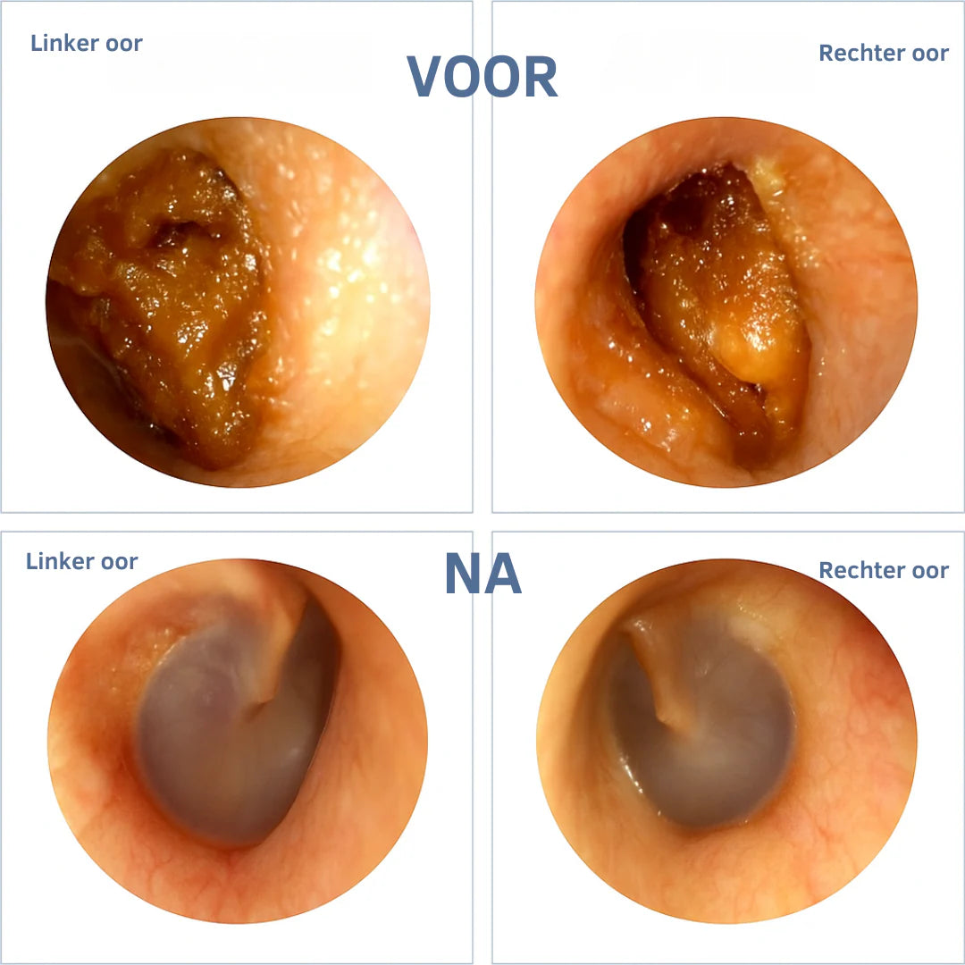 WaxView PRO | Slimme Oorreiniging Met HD Camera