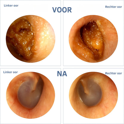 WaxView PRO | Slimme Oorreiniging Met HD Camera